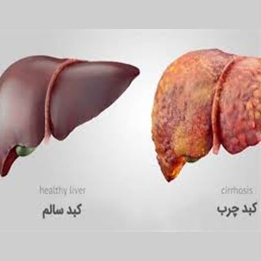 سئوالات کبد چرب