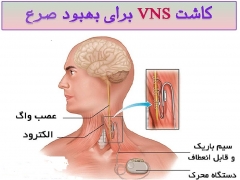 بهبود صرع با کاشت دستگاه  VNS